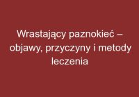 Wrastający paznokieć – objawy, przyczyny i metody leczenia