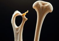 Osteoporoza: przyczyny, objawy i skuteczne metody leczenia