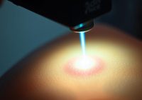 Laser punktowy w rehabilitacji – jak działa i jakie ma efekty?